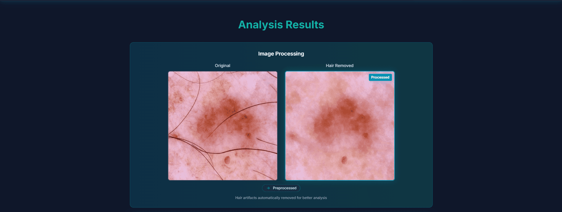 Preprocessing — hair-artifact removal
